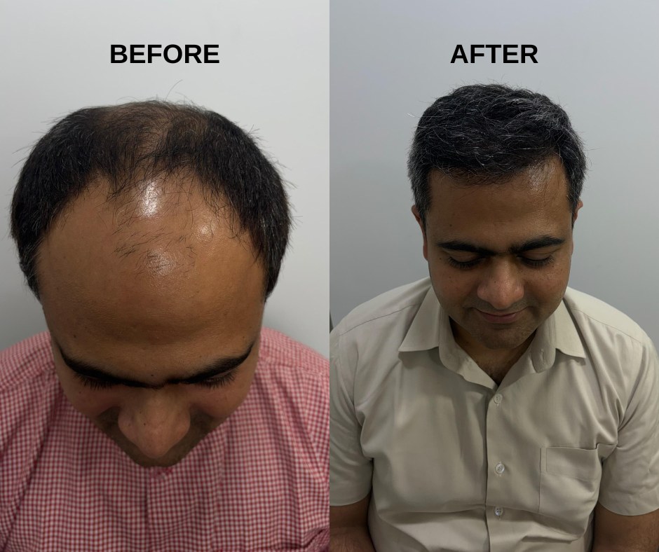 Hair transplant result 2