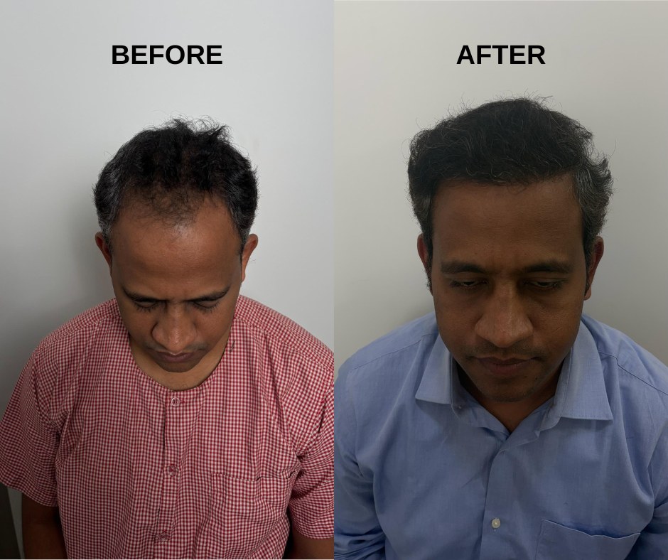 Crown area hair transplant result by HairSense doctor Mumbai